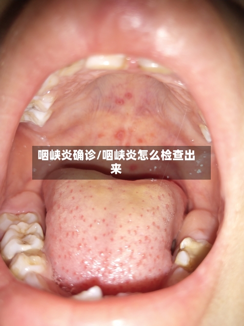 咽峡炎确诊/咽峡炎怎么检查出来-第2张图片