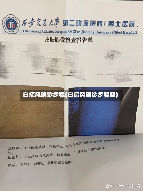 白癜风确诊步骤(白癜风确诊步骤图)-第3张图片