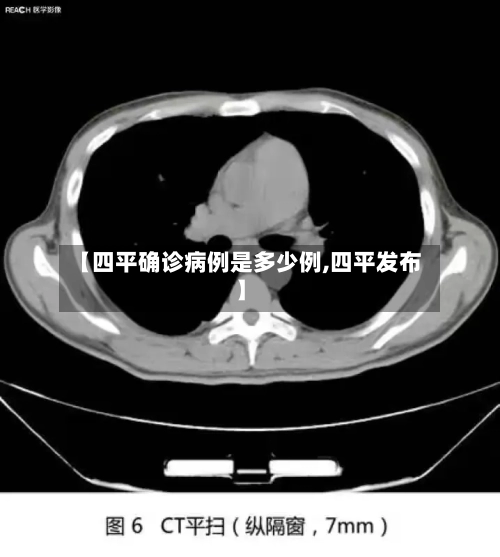 【四平确诊病例是多少例,四平发布】-第2张图片