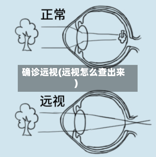 确诊远视(远视怎么查出来)-第2张图片
