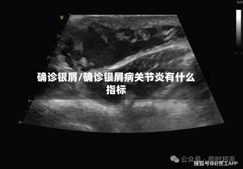 确诊银屑/确诊银屑病关节炎有什么指标