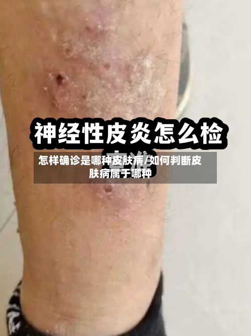 怎样确诊是哪种皮肤病/如何判断皮肤病属于哪种