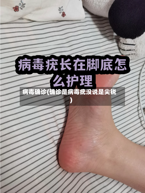 病毒确诊(确诊是病毒疣没说是尖锐)-第3张图片