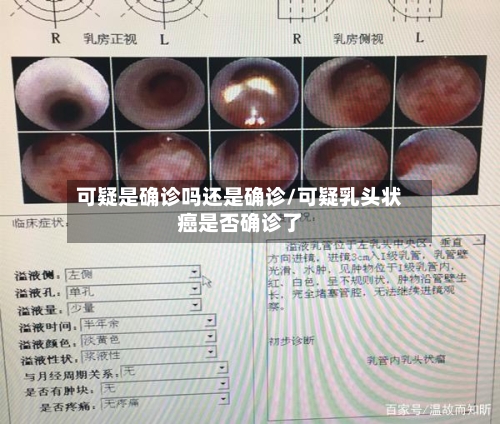可疑是确诊吗还是确诊/可疑乳头状癌是否确诊了