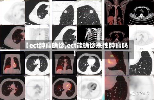 【ect肿瘤确诊,ect能确诊恶性肿瘤吗】-第2张图片
