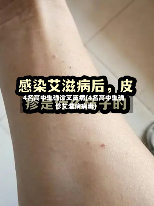 4名高中生确诊艾滋病(4名高中生确诊艾滋病病毒)