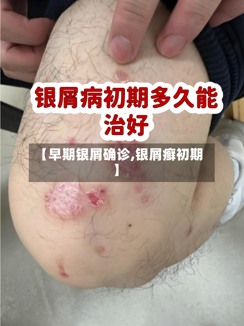 【早期银屑确诊,银屑癣初期】-第2张图片