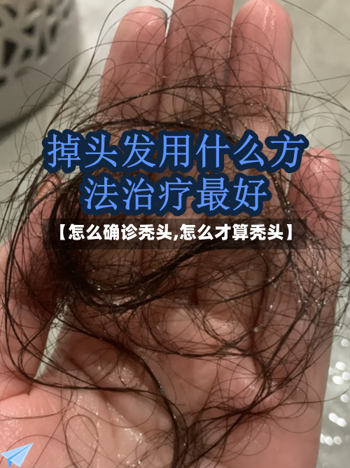 【怎么确诊秃头,怎么才算秃头】-第2张图片