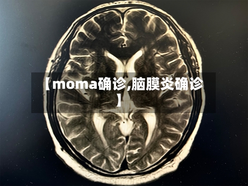【moma确诊,脑膜炎确诊】