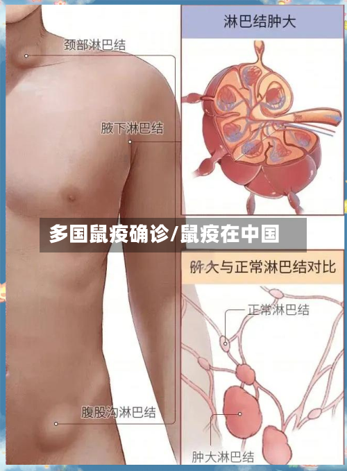 多国鼠疫确诊/鼠疫在中国-第2张图片