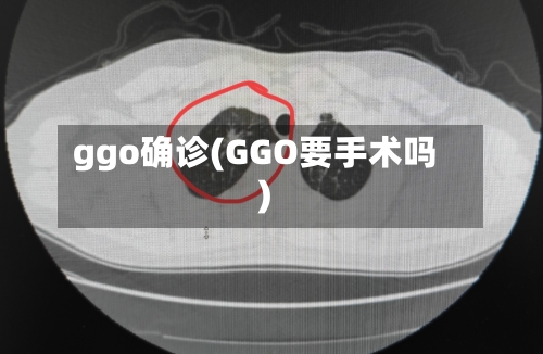 ggo确诊(GGO要手术吗)