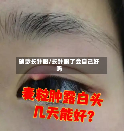 确诊长针眼/长针眼了会自己好吗-第2张图片