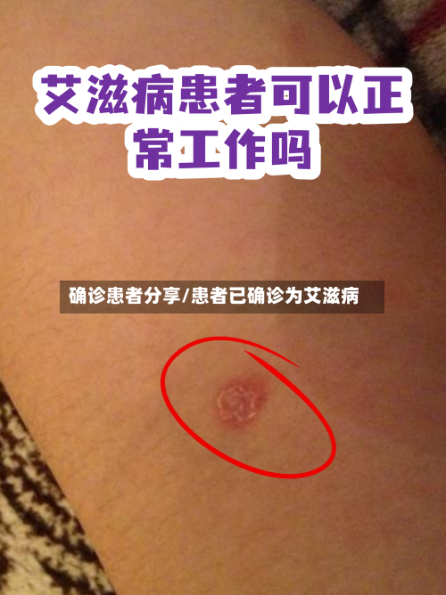 确诊患者分享/患者已确诊为艾滋病
